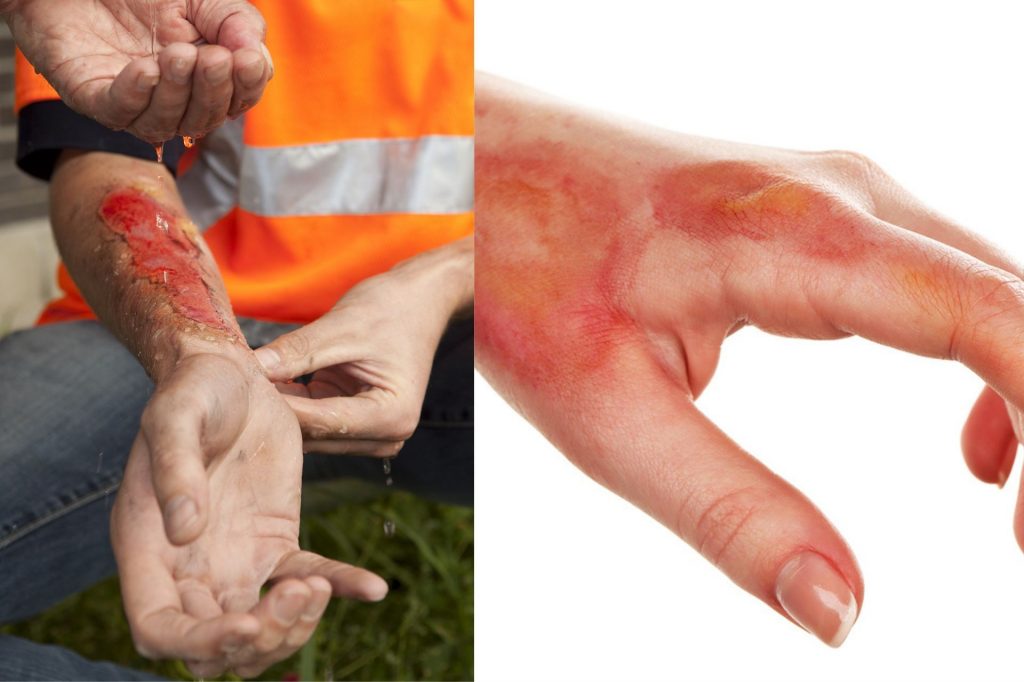 The Financial Struggles a Burn Injury Victim Will Face - types of burn injury