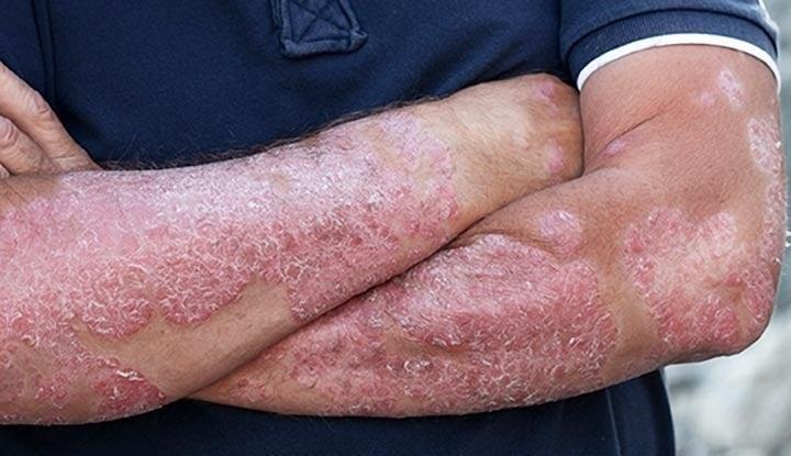 Psoriasis Only Attacks the Skin