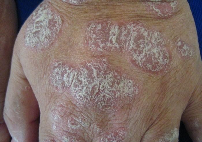 Separating Fact from Fiction about Psoriasis