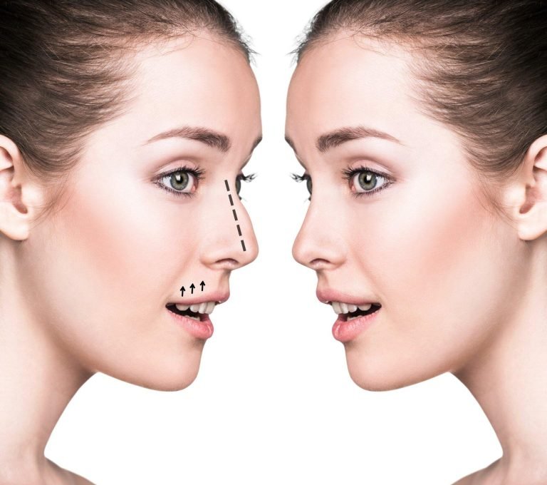 The Rising Trend of Asian Nose Reshaping: What You Need To Know Asian Nose Reshaping